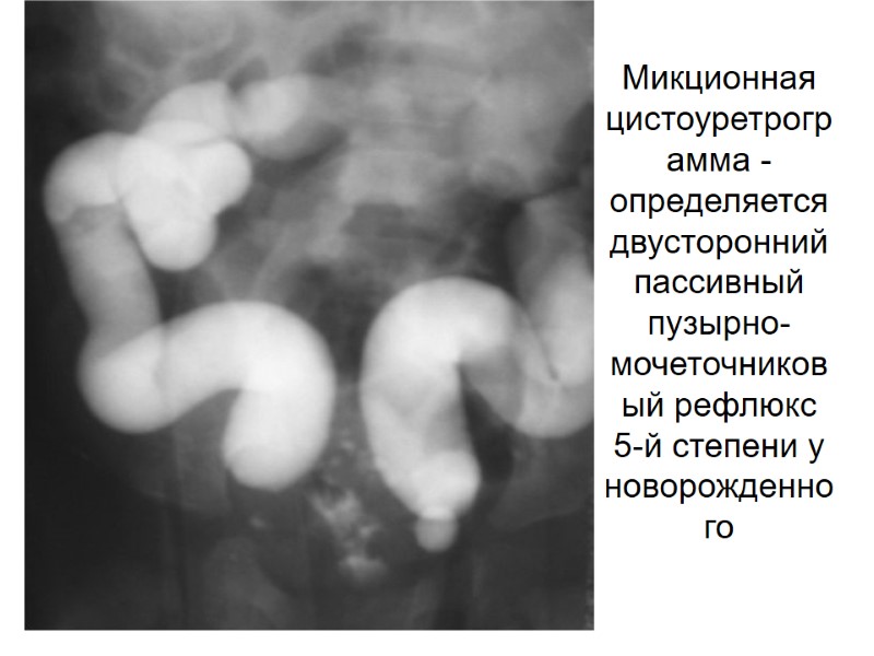 Микционная цистоуретрограмма - определяется двусторонний пассивный пузырно-мочеточниковый рефлюкс 5-й степени у новорожденного